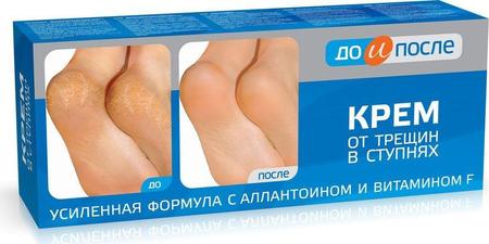 Фото До и После, крем от трещин в ступнях, 50 мл